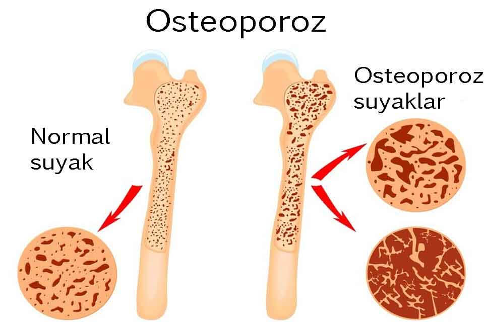 Osteoporoz kasalligi
