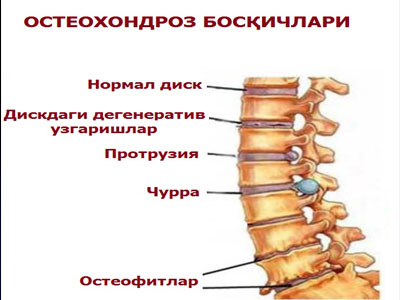 Osteoxondroz nima, sabablari, turlari, asoratlari.