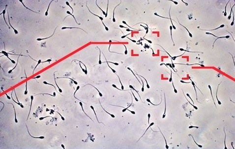 Spermatozoidlar agregatsiyasi nima va uni qanday davolash mumkin ?